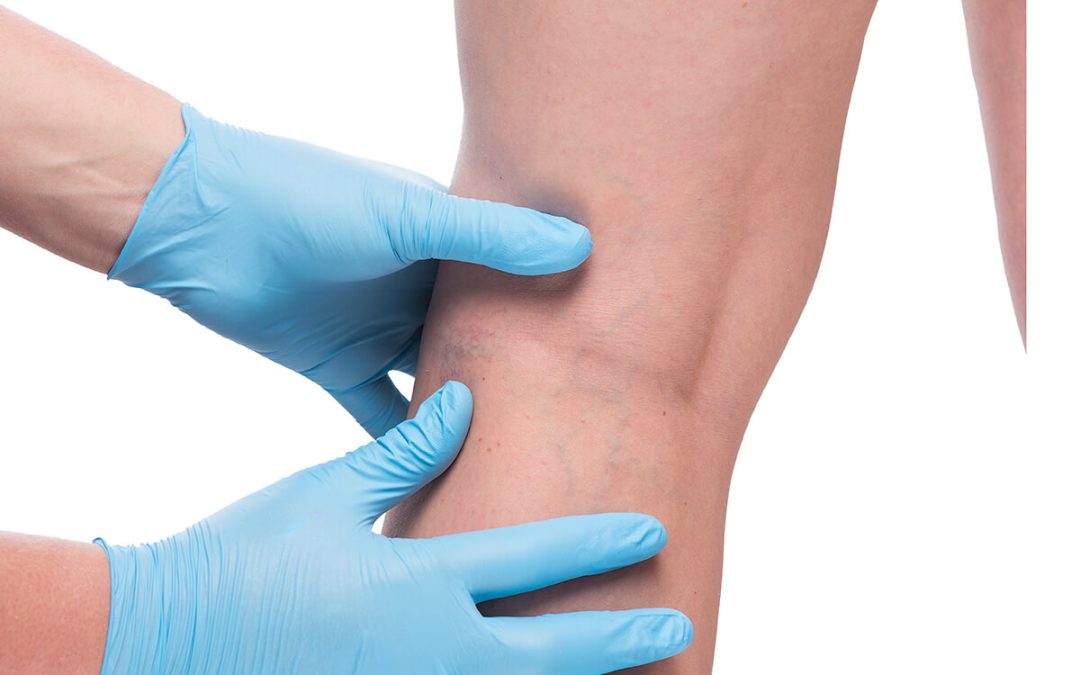 10 ways to recover from vertical veins treatment