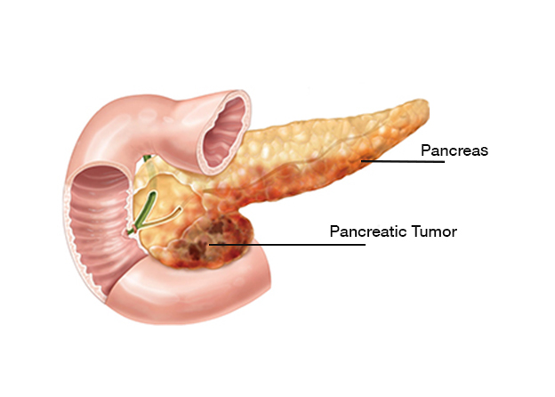 Latest Advancements in Pancreatic Cancer Treatment